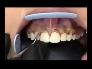 plasty of the gums with a laser.